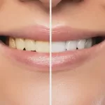 How Teeth Whitening Is Evolving in Modern Dental Care